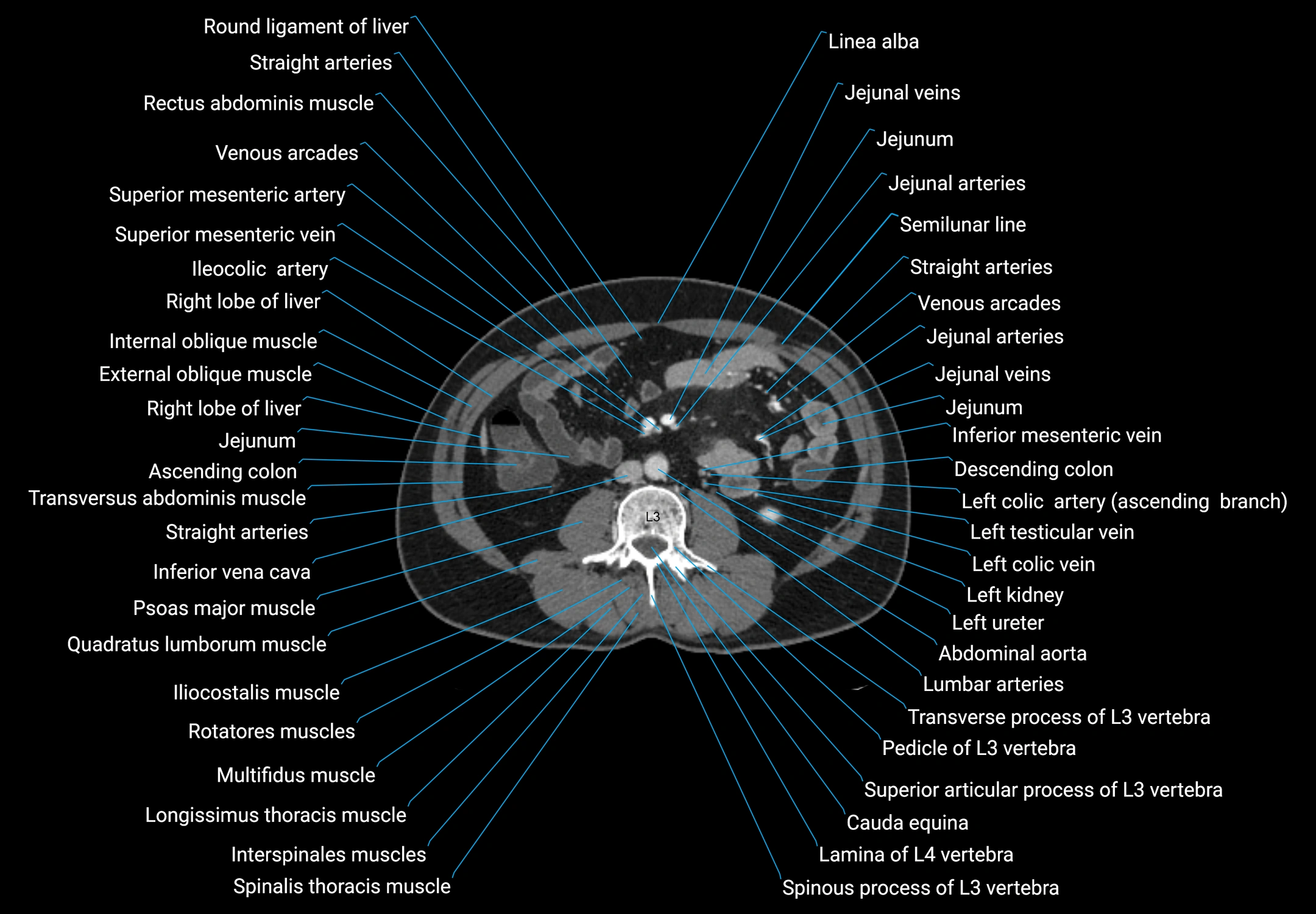CT male pelvis axial cross sectional anatomy labelled radiology image -00090.webp